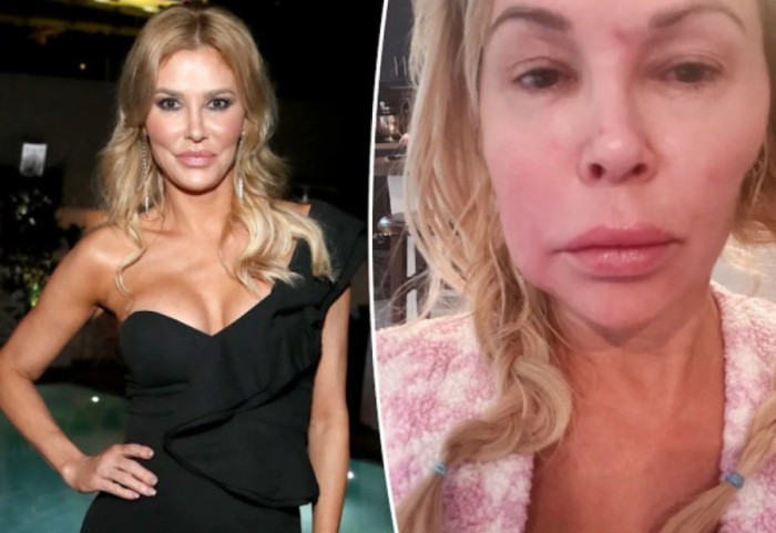 “Më shpërtheu implanti i gjoksit”, ylli televiziv zbulon arsyet e shpërfytyrimit